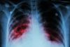Chest x-ray